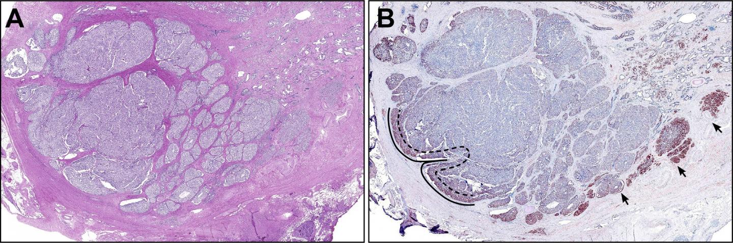 Biomarker May Help Identify Men With Prostate Cancer At Greater Risk Of Tumor Metastasis