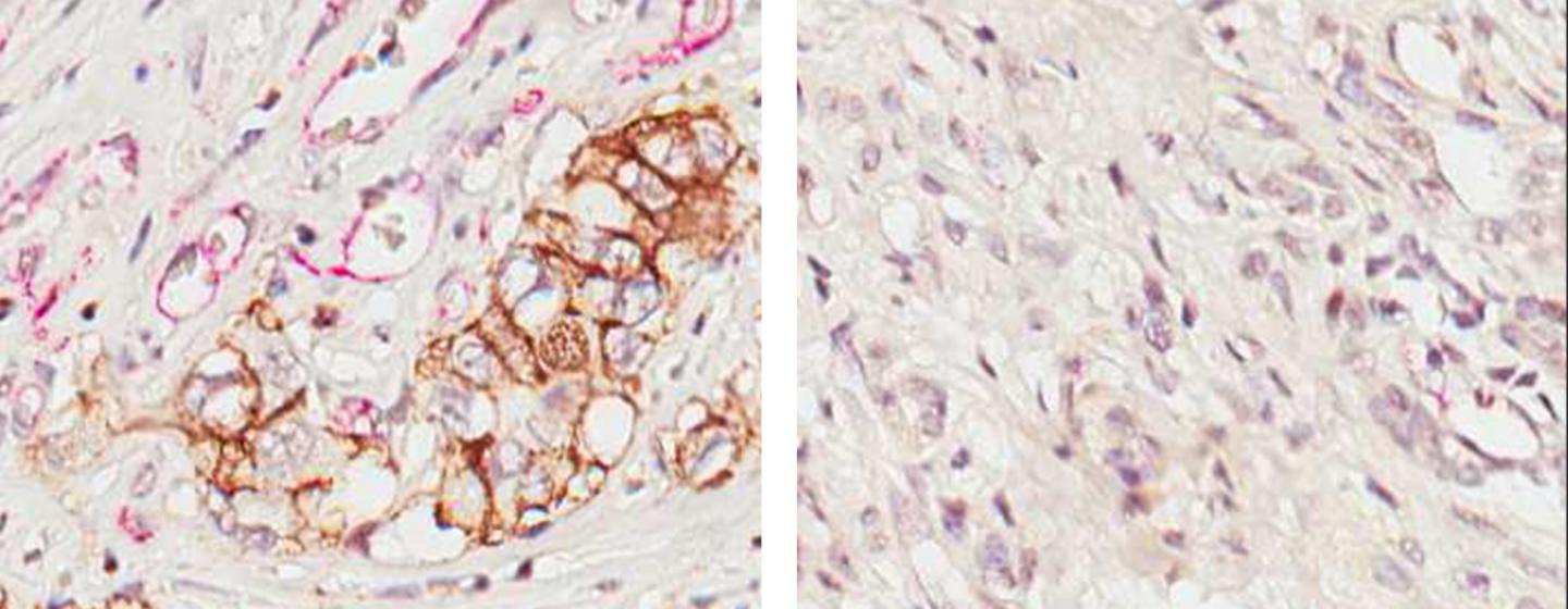 IL-17B and Pancreatic Cancer