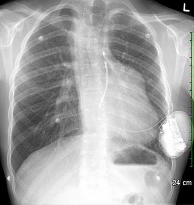 Chest X-Ray