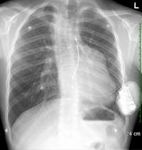 Chest X-Ray