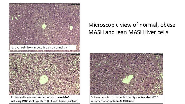 Microscopic view of normal, obese MASH and lean liver MASH cells