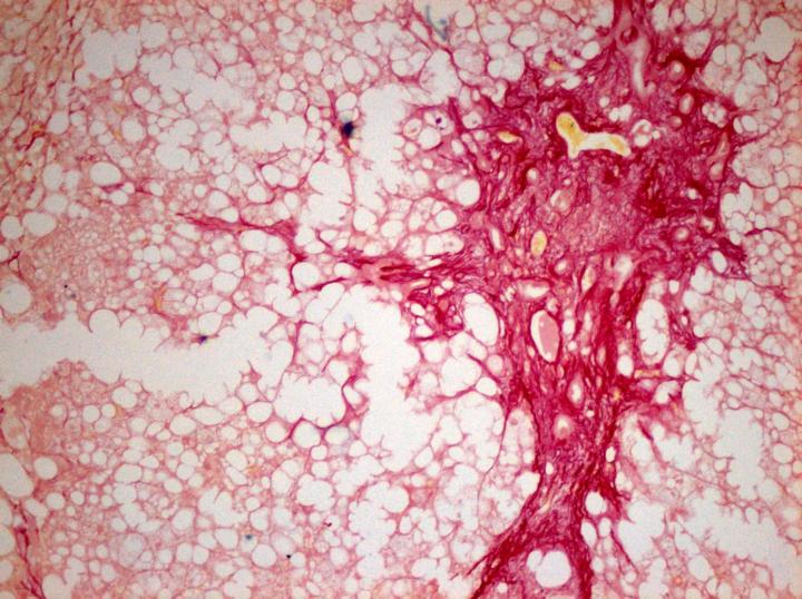 Liver Fibrosis