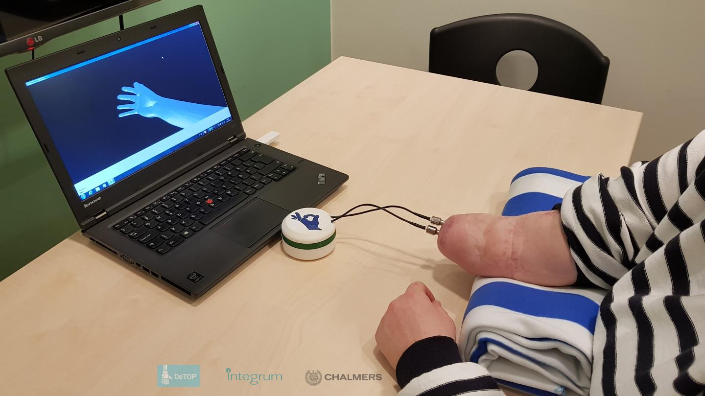The First Person with Below-Elbow Amputation Implanted with An Osseo-Neuromuscular Prosthesis
