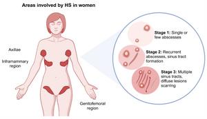 Areas involved by HS in women