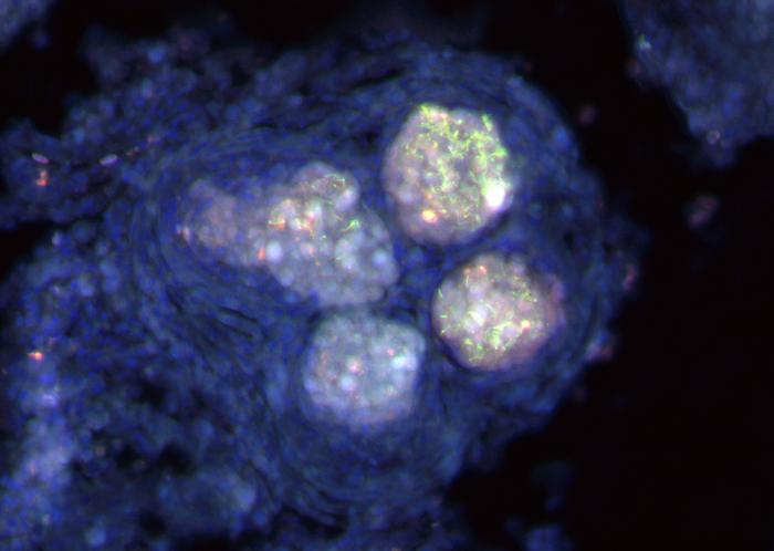 A multi-lobed M. marinum granuloma in adult zebrafish 2 weeks post secondary M. abscessus infection