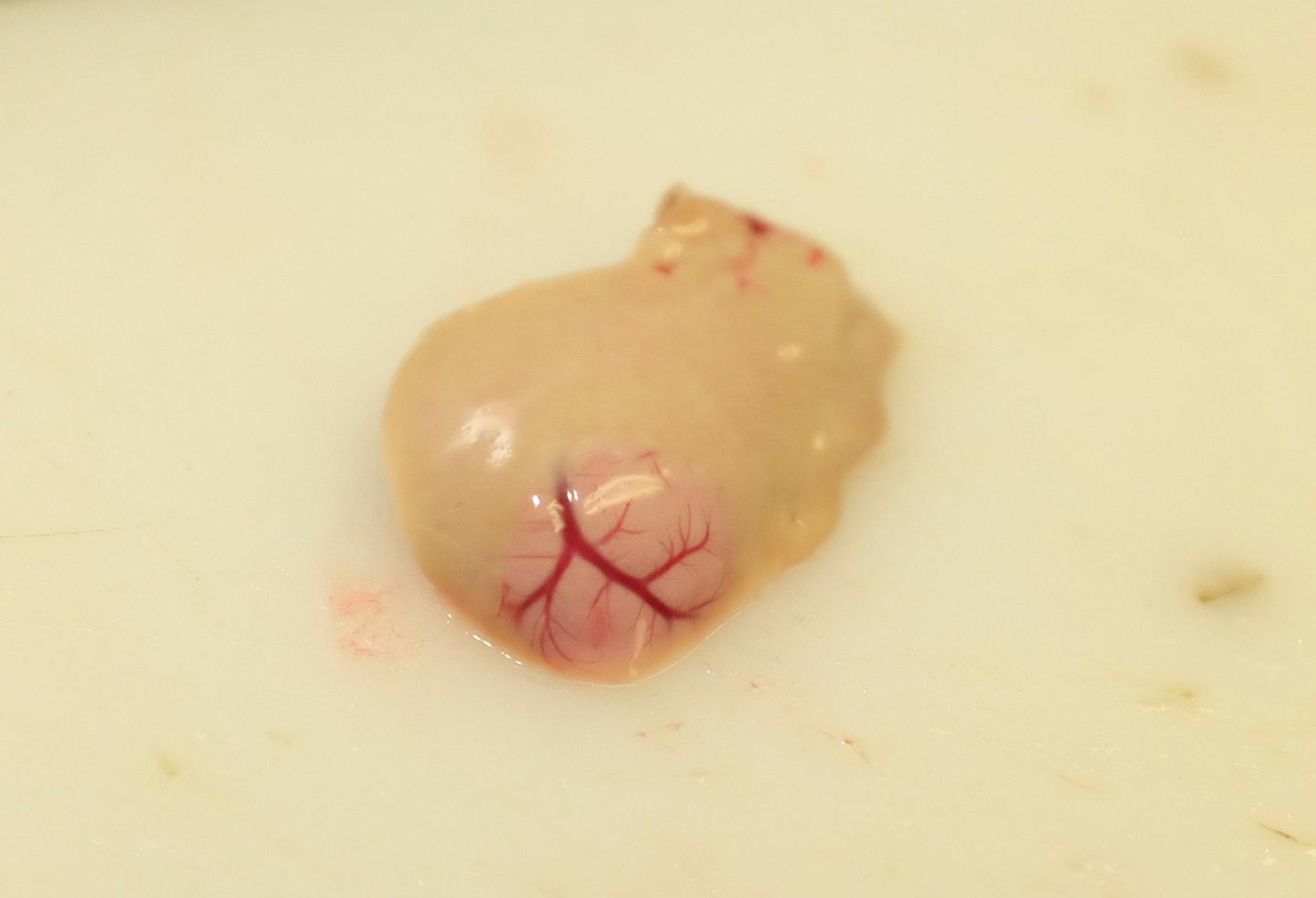 Liver Tumour