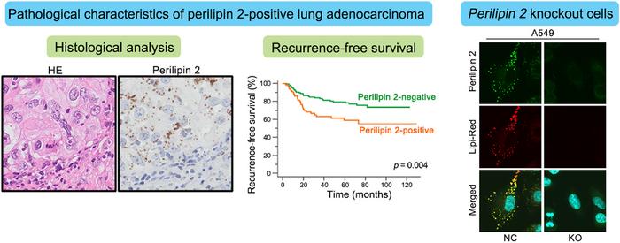 Pathological characteristics of perilipin 2-positive lung adenocarcinoma