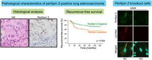 Pathological characteristics of perilipin 2-positive lung adenocarcinoma