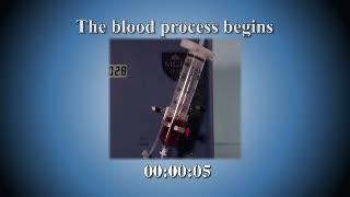 iChip Spots Circulating Tumor Cells (2of 4)