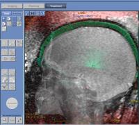 Focused Ultrasound Rays Converge Deep in the Brain of a Patient