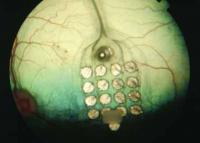 Retinal Implant