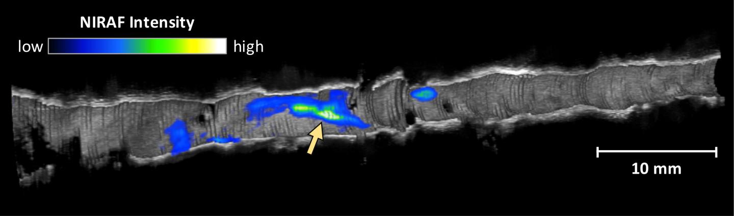 OCT-NIRAF Imaging of Coronary Artery