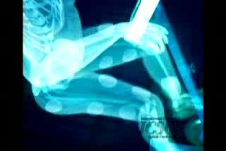 Simulation of Functional Electrical Stimulation Cycling
