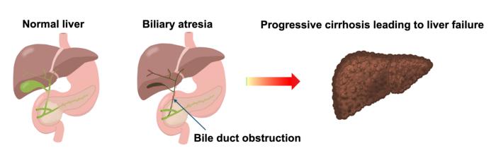 Development of biliary atresia