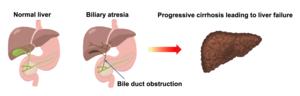 Development of biliary atresia