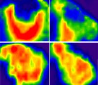 Recovery from Stroke