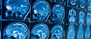 MRI scan