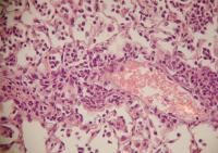 Discovery May Help Patients Beat Deadly Bacterial Pneumonia (1 of 2)