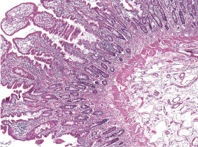 CHAPLE Disease