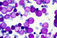 Close-Up Bone Marrow Slide 1992