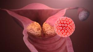 Nasal vaccine shows promise as a non-invasive treatment for cervical cancer
