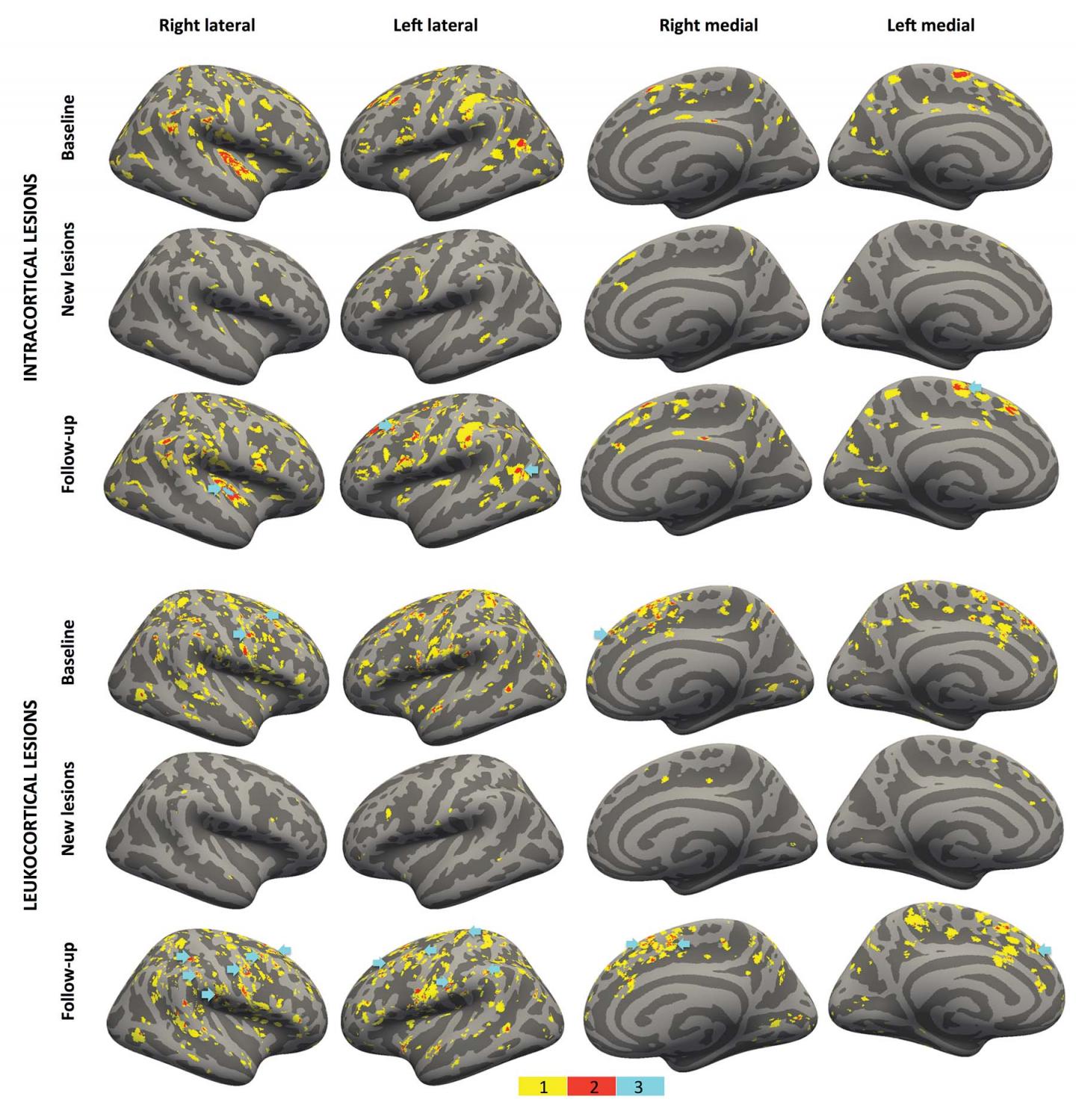 High-Strength MRI Tracks MS Progression