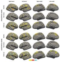High-Strength MRI Tracks MS Progression
