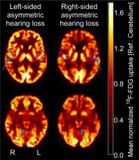 Axial 18F-FDG PET scans at level of primary auditory cortex and inferior colliculus.