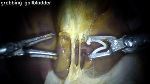 Robot performs gallbladder procedure: Example 1