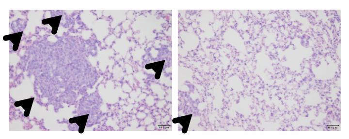 The Osteoporosis Drug Zoledronic Acid Suppresses Breast Cancer Cell Metastasis