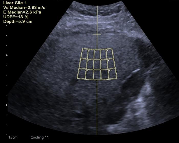 Expert consensus on the use of ultrasound‐derived fat fraction (UDFF) to evaluate liver steatosis