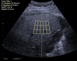 Expert consensus on the use of ultrasound‐derived fat fraction (UDFF) to evaluate liver steatosis