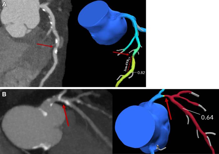 Coronary CT angiography images