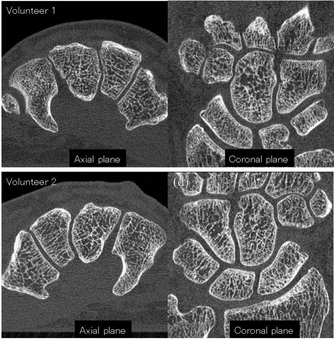 Figure 2.  CT images of the hands (carpal region) of two healthy volunteers acquired with the developed system.