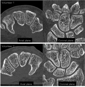 Figure 2.  CT images of the hands (carpal region) of two healthy volunteers acquired with the developed system.