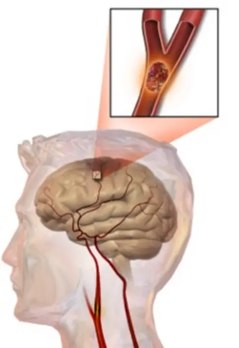 Illustration of an ischemic stroke caused by the blockage of a cerebral artery.