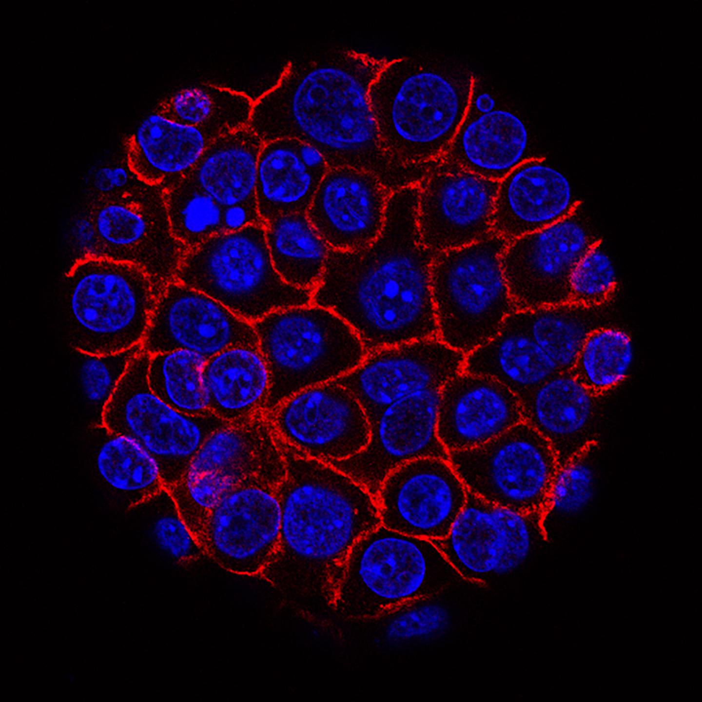 The Fluid That Feeds Tumor Cells
