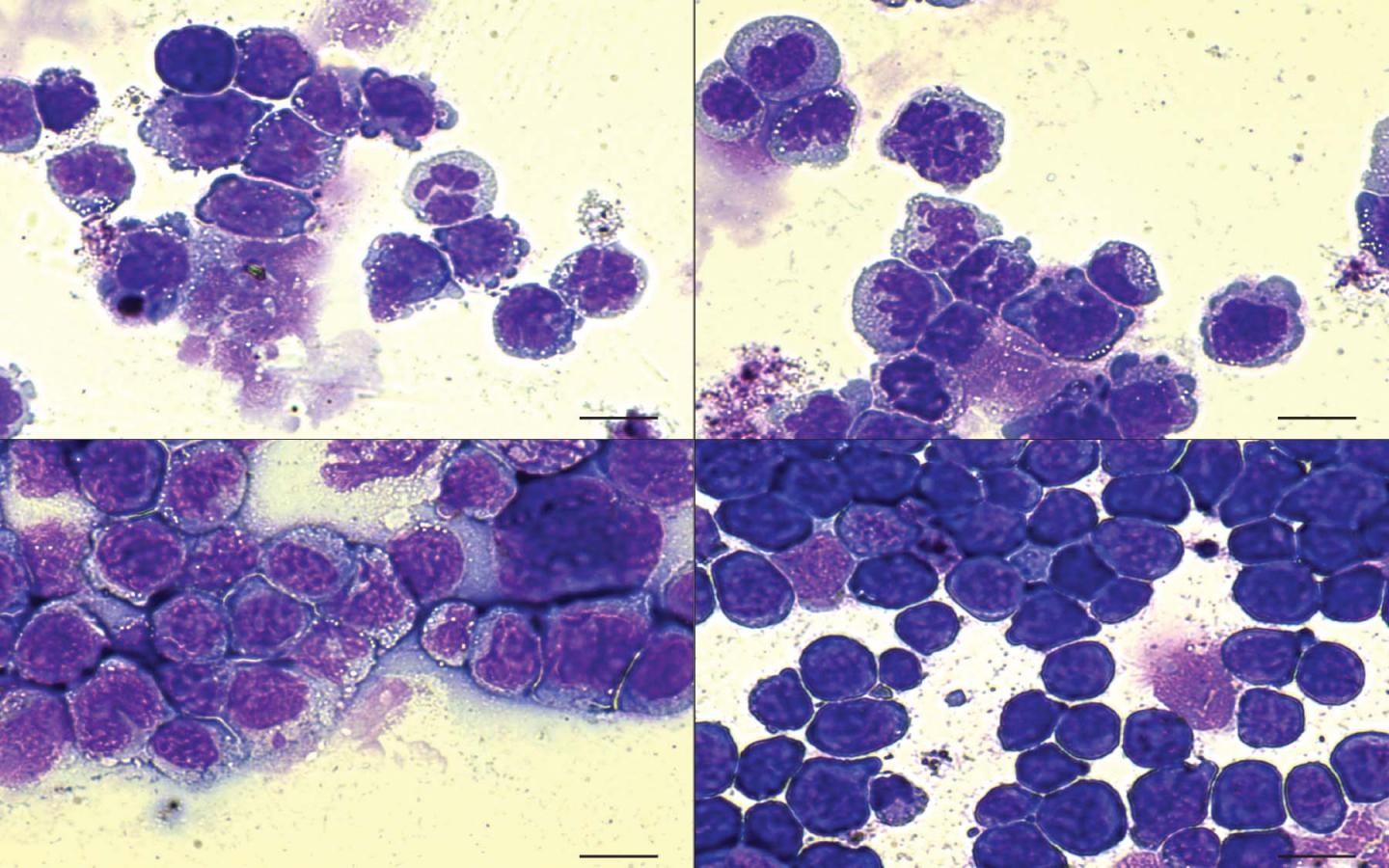 AML Defective Blood Cells