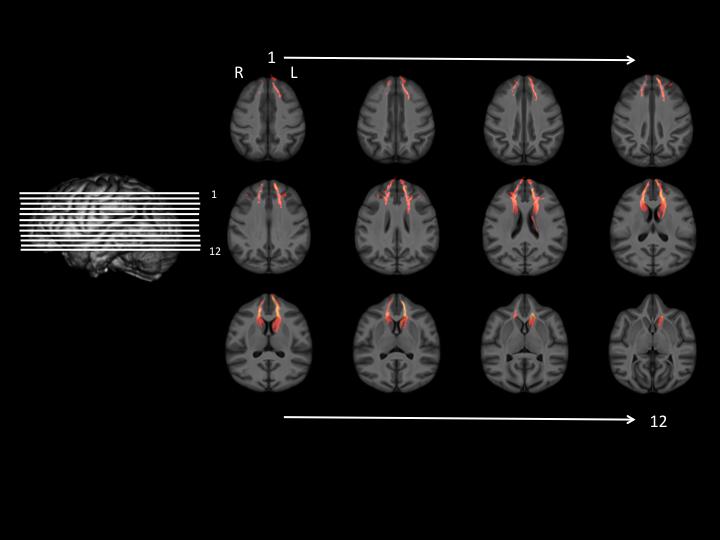 Serial Views of Chimpanzee Brain