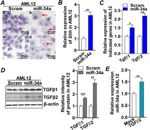 Increased miR-34a induced hepatocyte ballooning degeneration and fibrogenic status.