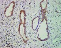 Tissue with Tumors -- Brown CEPB-4