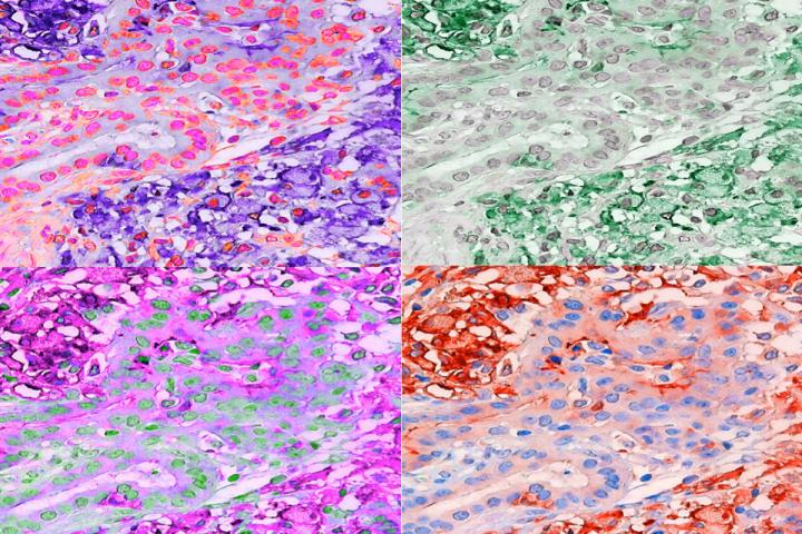 Colorized Human Tumor with Macrophage Infiltrate