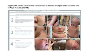 Scorecard to help pediatricians identify severe eczema
