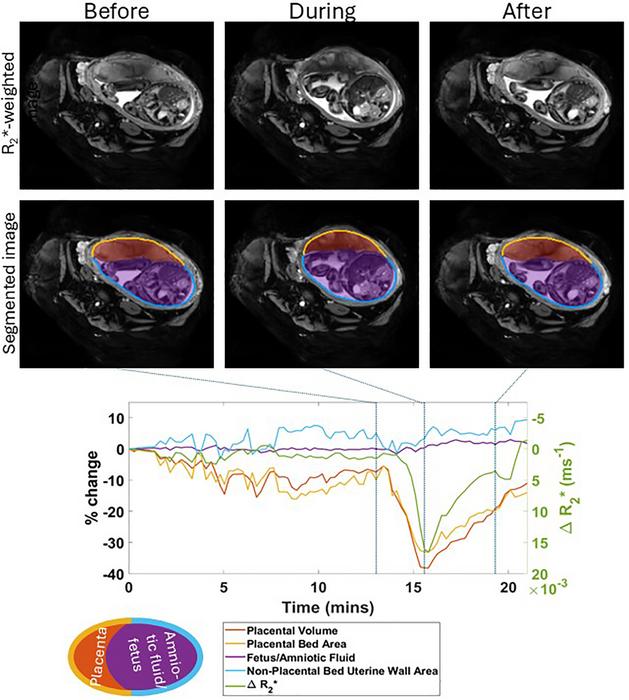 Placental contractions in uncomplicated pregnancies