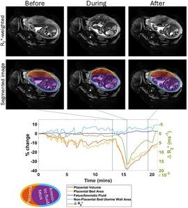 Placental contractions in uncomplicated pregnancies