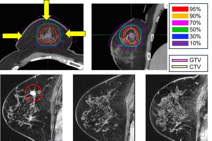 Carbon-Ion Therapy Spares Surgery