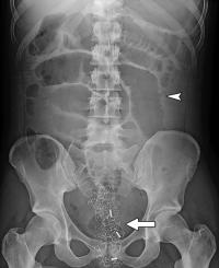 Single-Stage Vaginoplasty Anatomy