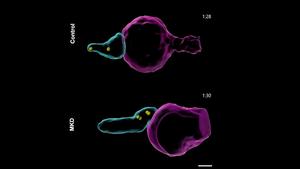 Human immune cells from an MKD patient misfiring