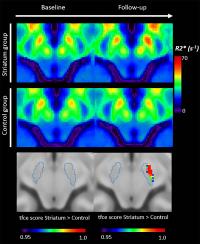 Iron Measurements with MRI Reveal Stroke's Impact on Brain (2 of 3)