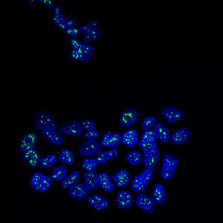 Breast Cancer Metastasis